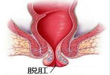 大理肛泰肛肠医院：脱肛和痔疮有什么不同？