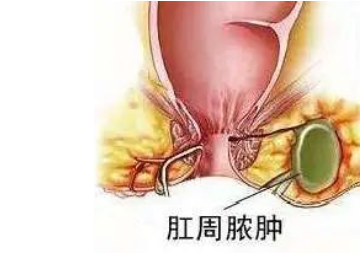 大理肛泰肛肠医院：“菊花疼”不一定是痔疮，小心肛周脓