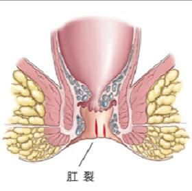 大理肛泰肛肠医院：肛裂是怎么回事？是什么引起肛裂？