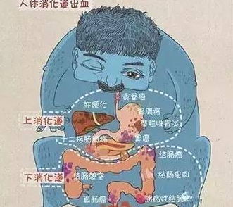 大理肛泰肛肠医院：便血是痔？还是癌？