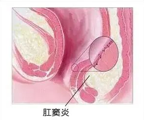 大理肛泰肛肠医院：肛窦炎是如何诱发其它肛肠疾病的？