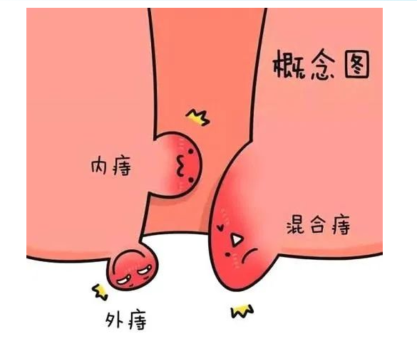 大理肛泰肛肠医院：外痔该怎么治？