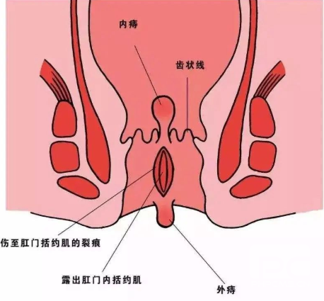 大理肛泰肛肠医院：令人难以忍受的酷刑——肛裂