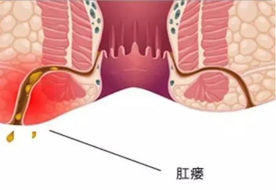 大理肛泰肛肠医院：肛瘘和痔疮有什么区别？