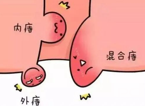 大理肛泰肛肠医院：混合痔，一种不能小看的疾病