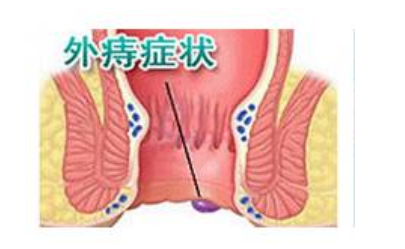 大理肛泰肛肠医院：外痔一定要手术切除吗?