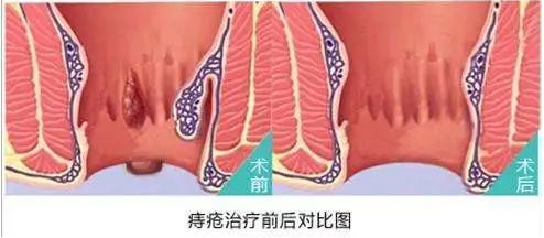 大理肛泰肛肠医院：外痔那个疙瘩会变小吗？