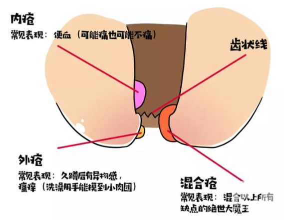 大理肛泰肛肠医院：大便便血的四大原因是什么