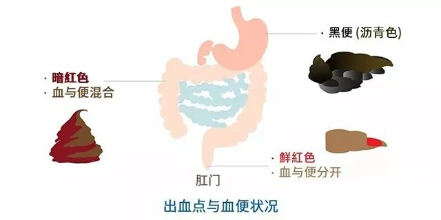 大理肛泰肛肠医院：大便便血的四大原因是什么
