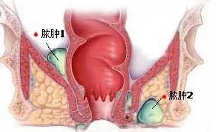大理肛泰肛肠医院：肛周脓肿的7大危害