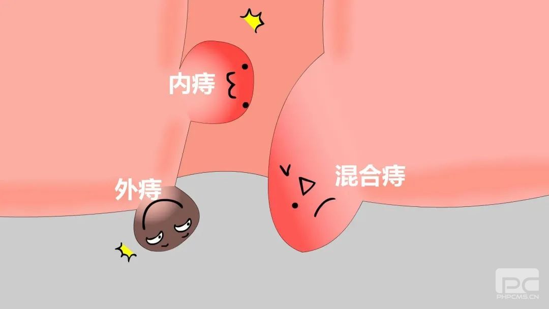 大理肛泰肛肠医院：外痔到底是什么痔?