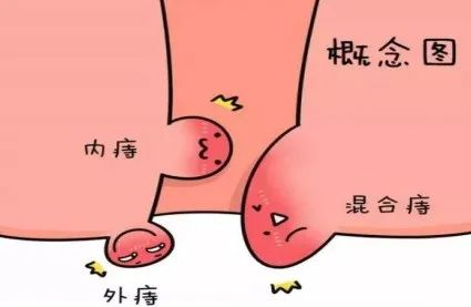 大理肛泰肛肠医院：四类不同的外痔症状表现