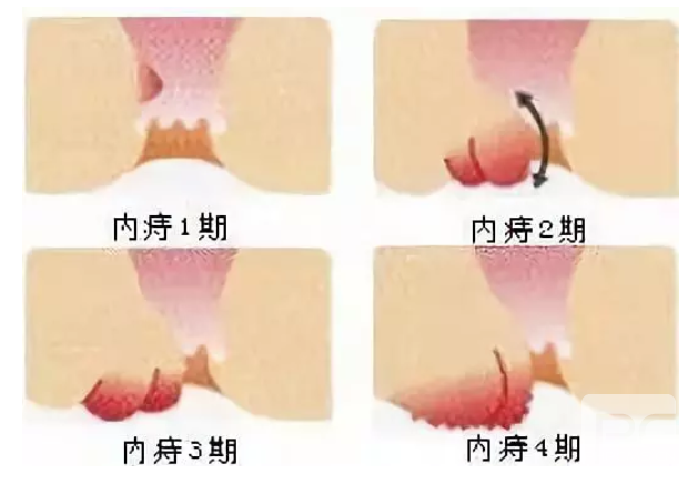 大理肛泰肛肠医院：内痔的症状是什么呢？