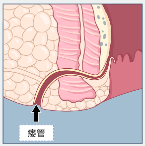 大理肛泰肛肠医院：肛瘘常见症状表现是什么