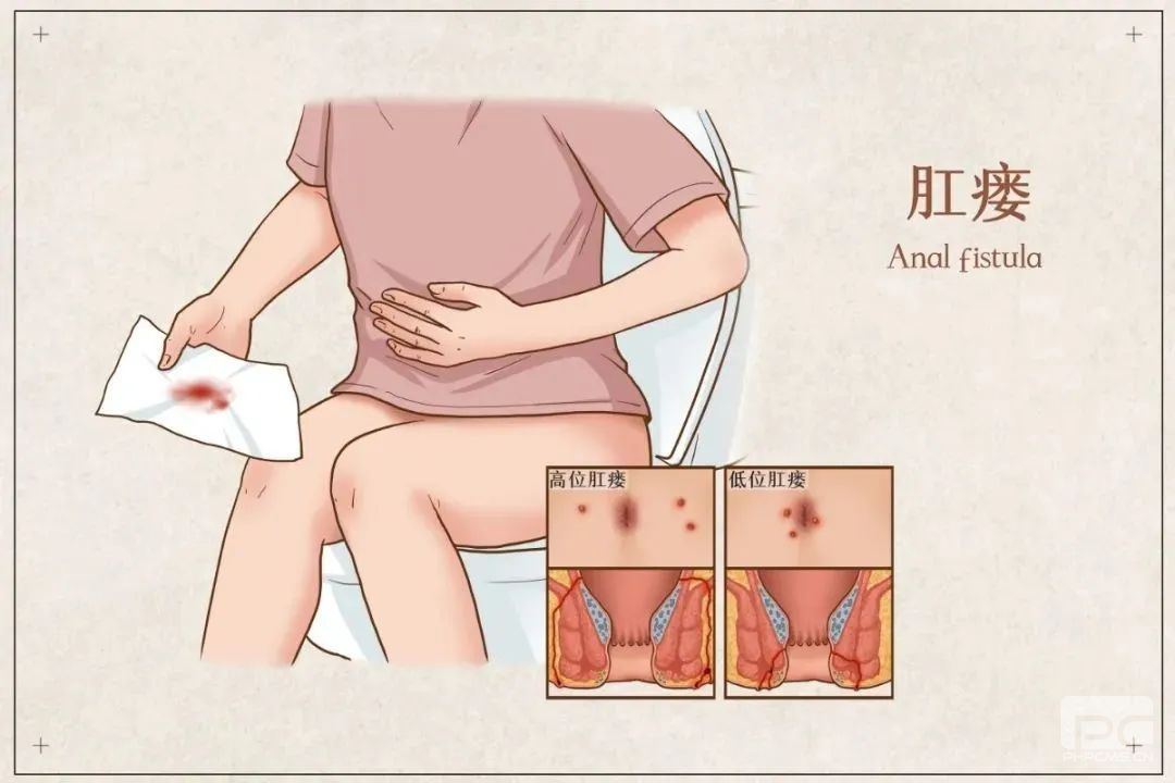 大理肛泰肛肠医院：肛瘘是怎么形成的呢?