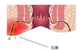 大理肛泰肛肠医院：为什么肛瘘一定要尽早手术？