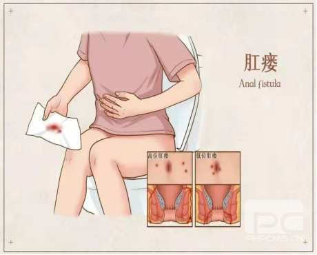 大理肛泰肛肠医院：为什么肛瘘一定要尽早手术？