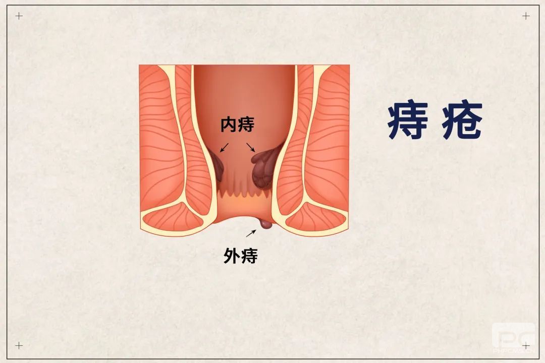 大理肛泰肛肠医院：内痔的预防措施有哪些?