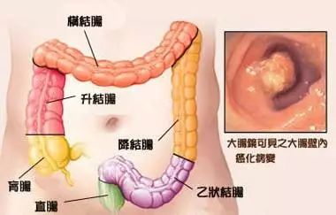 大理肛泰肛肠医院：直肠炎常见的症状表现有哪些？