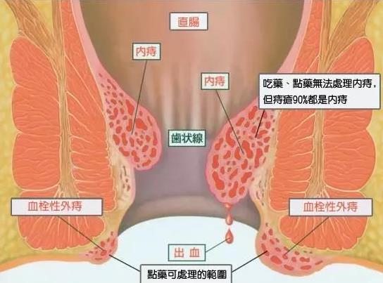 大理肛泰肛肠医院：脱肛到底“脱”的是什么？