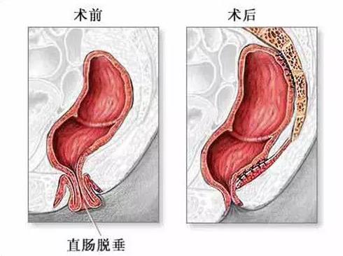 大理肛泰肛肠医院：脱肛到底“脱”的是什么？