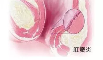 大理肛泰肛肠医院：什么是肛窦炎呢