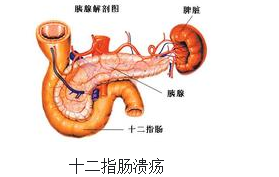 大理肛泰肛肠医院：得了十二指肠炎有哪些症状表现？