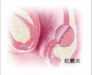 大理肛泰肛肠医院：肛窦炎是什么原因在“作祟”？