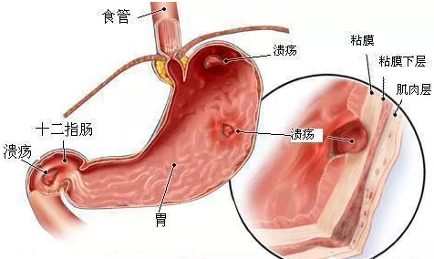 大理肛泰肛肠医院：十二指肠炎久拖不治危害大