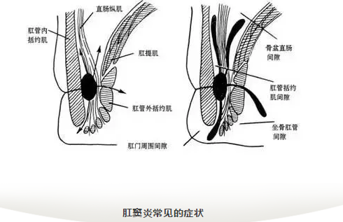 大理肛泰肛肠医院：肛窦炎的症状表现有哪些？