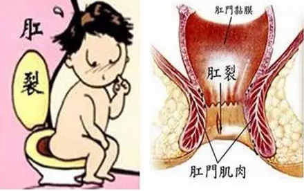大理肛泰肛肠医院：肛裂会不会传染呢？