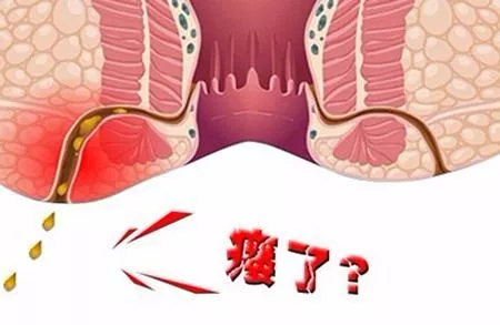 大理肛泰肛肠医院：肛瘘应该怎么办？一定要手术吗？