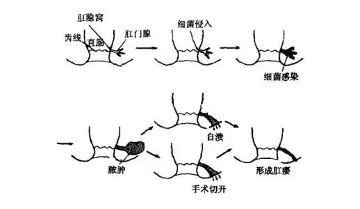 大理肛泰肛肠医院：肛窦炎的危害有哪些