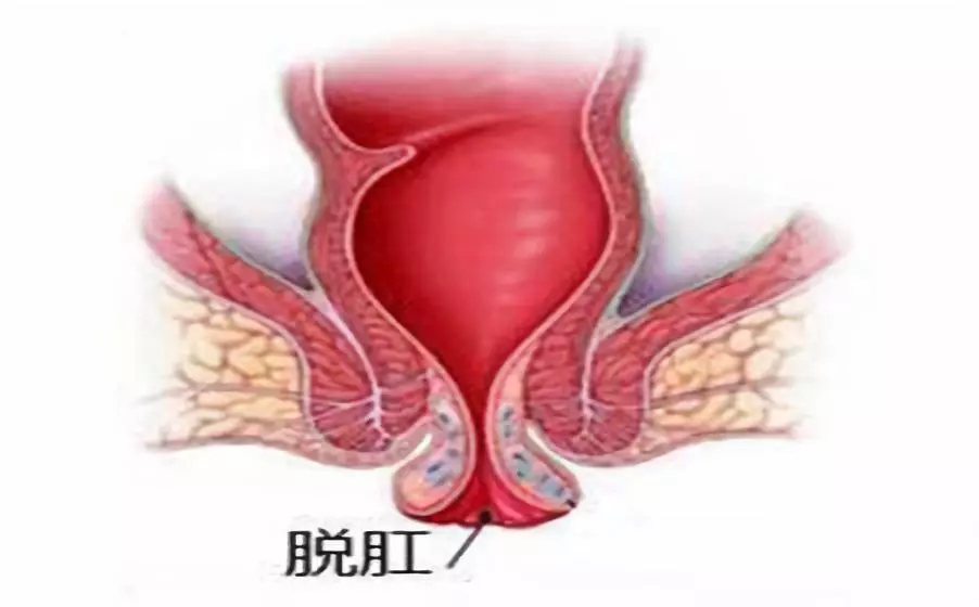 大理肛泰肛肠医院：脱肛是怎么回事儿？