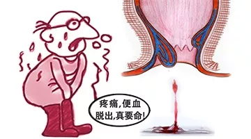 大理肛泰肛肠医院肛裂了，真的要动刀？