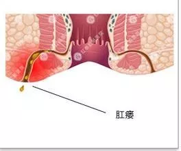 大理肛泰肛肠医院：对于“肛瘘”，你可能不知道的那些事儿!