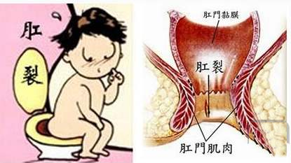 大理肛泰肛肠医院：便秘把“菊花撑破”了，怎么办？