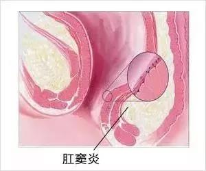 大理肛泰肛肠医院：误以为是痔疮，肛窦炎的症状你了解多少？