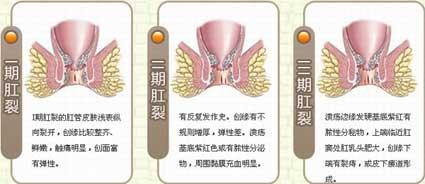 大理肛泰肛肠医院：肛裂怎么办？你知道肛裂可分为哪几个时期吗？