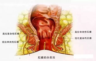 大理肛泰肛肠医院;肛瘘并不能自愈，你还怕尴尬不去医院？
