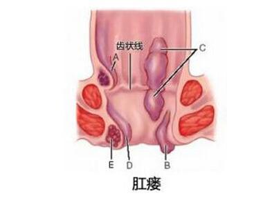 大理肛泰肛肠医院;肛瘘罪大恶极，与其对抗绝不手软！