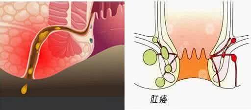 大理肛泰肛肠医院：人人谈癌色变，肛瘘到底会不会癌变