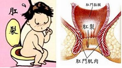 大理肛泰肛肠医院：为何菊花又痛又痒？因为你可能得肛裂了