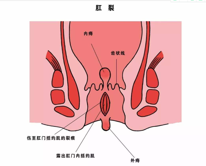 大理肛泰肛肠医院：肛裂怎么治？治疗肛裂其实很简单 