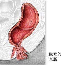 大理肛泰肛肠医院：直肠脱垂的危害是什么