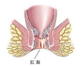 大理肛泰肛肠医院：轻度肛裂的超简单治疗手段