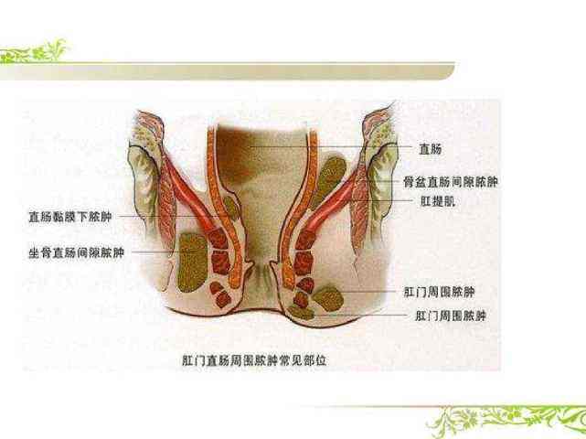 大理肛泰肛肠医院：肛瘘哪些典型的症状让人印象深刻？