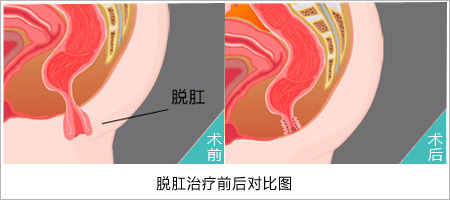 大理肛泰肛肠医院;“脱肛”脱出的究竟是什么？ 
