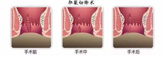 大理肛泰肛肠医院：肛裂手术后需要注意这些 