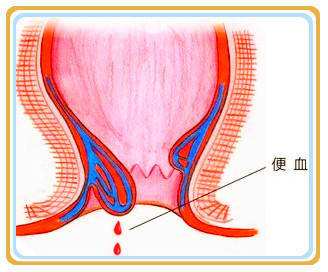大理肛泰肛肠医院：便血了？别慌！这六大疾病常是大便出血“元凶”